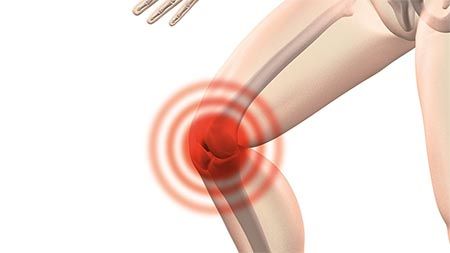 Arthrose im Knie: Behandlung mit Hyaluronsäure und PRP