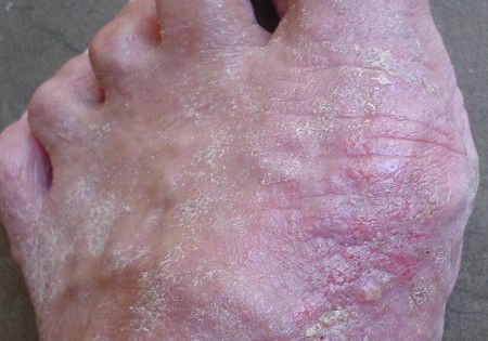allergie1
