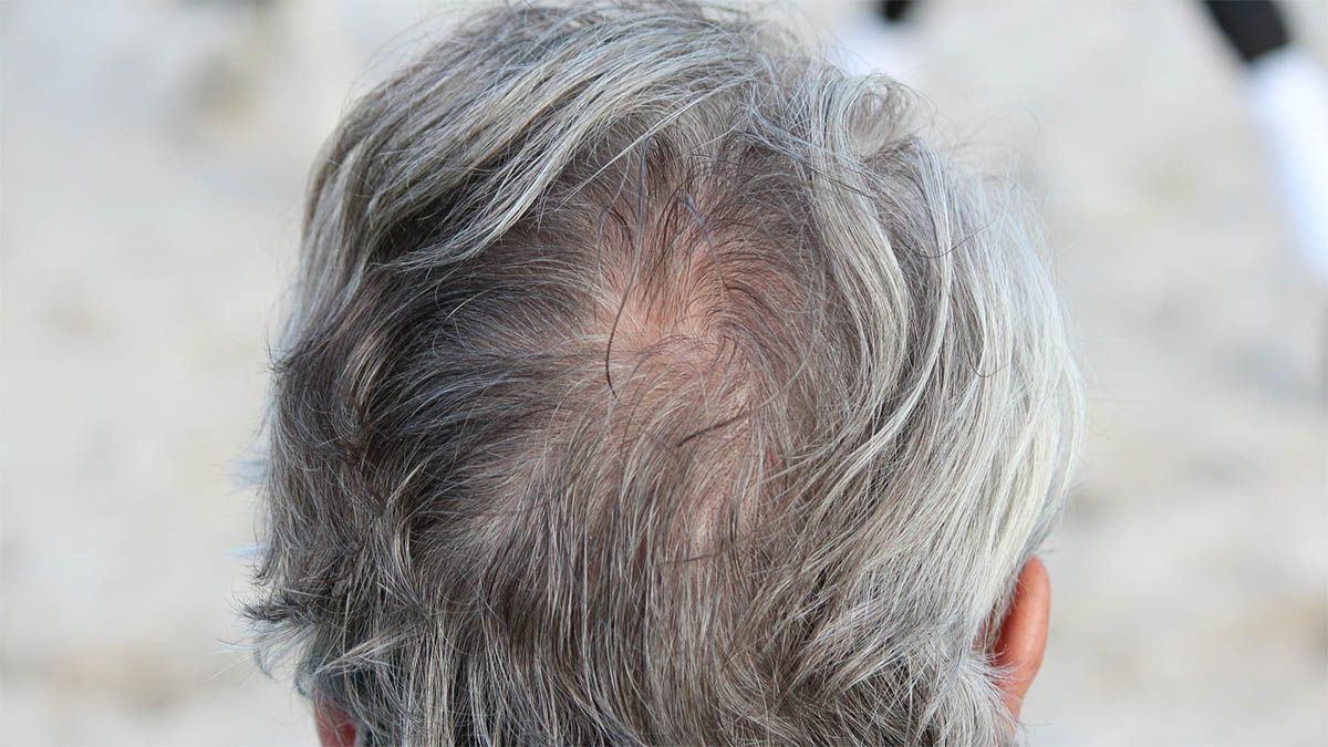 Wann lohnt sich eine Haartransplantation hinterkopf schuetteres haar