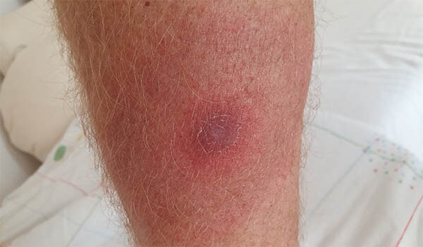 dr gonzalez borreliose hautbild