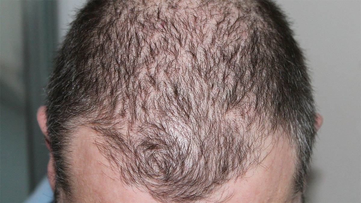 Wie man effektiv gegen Haarverlust vorgeht mann schuetteres haar geheimratsecken